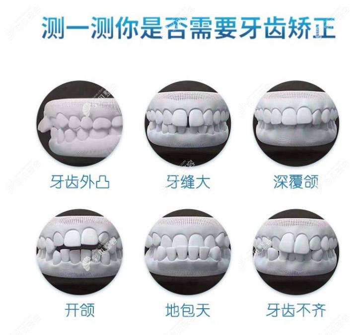 哪些牙齿需要牙齿矫正