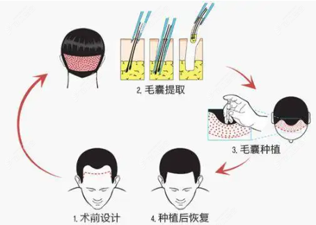 西安米兰柏羽的雷惠斌医生做植发的过程www.cbzr.com