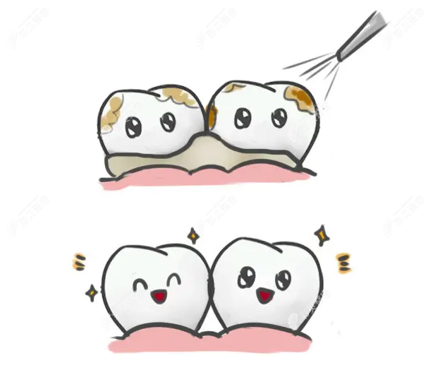 隋嘉宁医生洗牙前后牙齿对比图m.cbzr.com