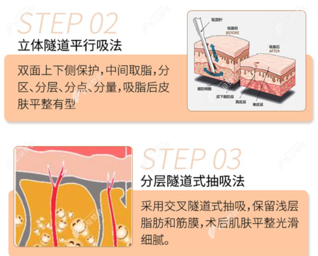 王永功医生抽脂技术