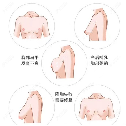 王永功改善的胸部问题