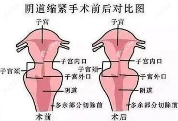 ​广州缩阴手术哪里做得好?广州曙光/华美做私密整形排名好