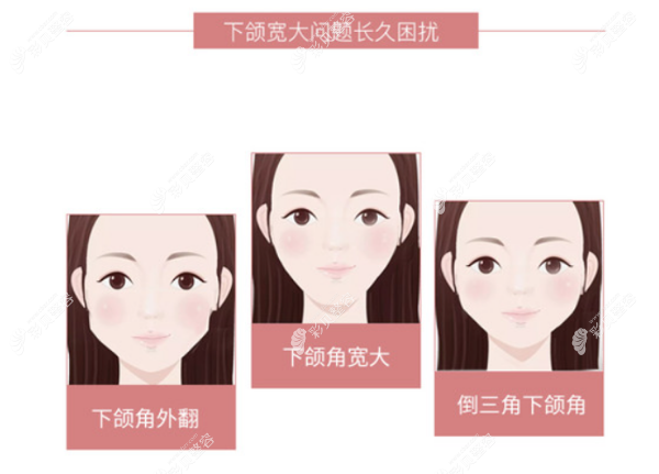 下颌角截骨手术适合人群有哪些