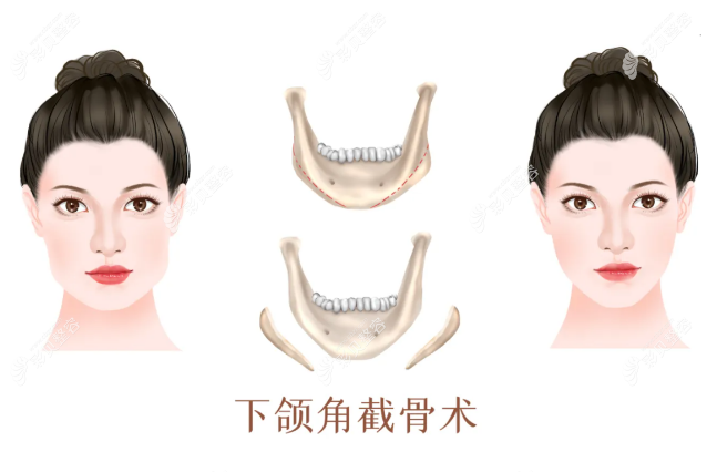 武汉下颌角截骨整形一般多少钱