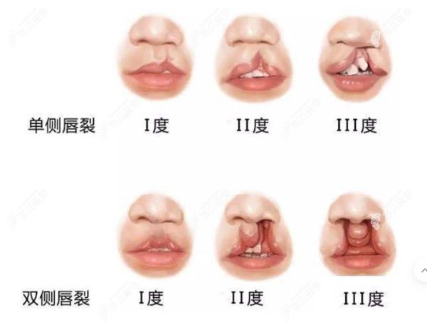 唇腭裂分单侧和双侧唇裂两种