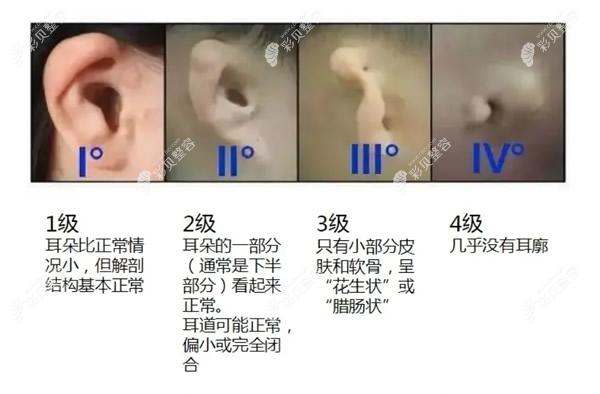 小耳畸形等级分类图片