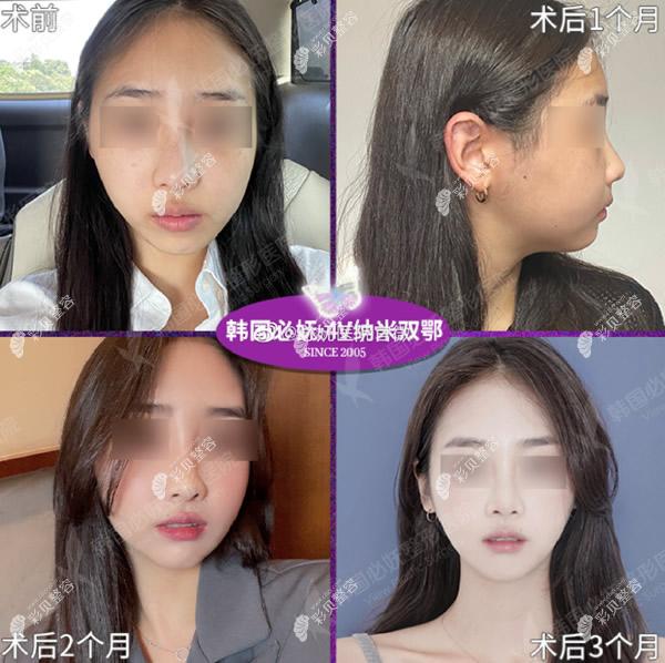 韩国必妩医院双鄂手术图片