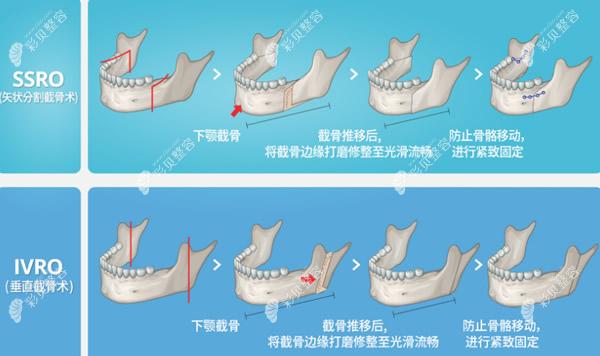 必妩医院下颚手术操作过程和步骤图解