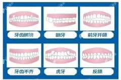 广州曙光口腔牙齿矫正价格表,近期做隐形矫牙费用立减6000元