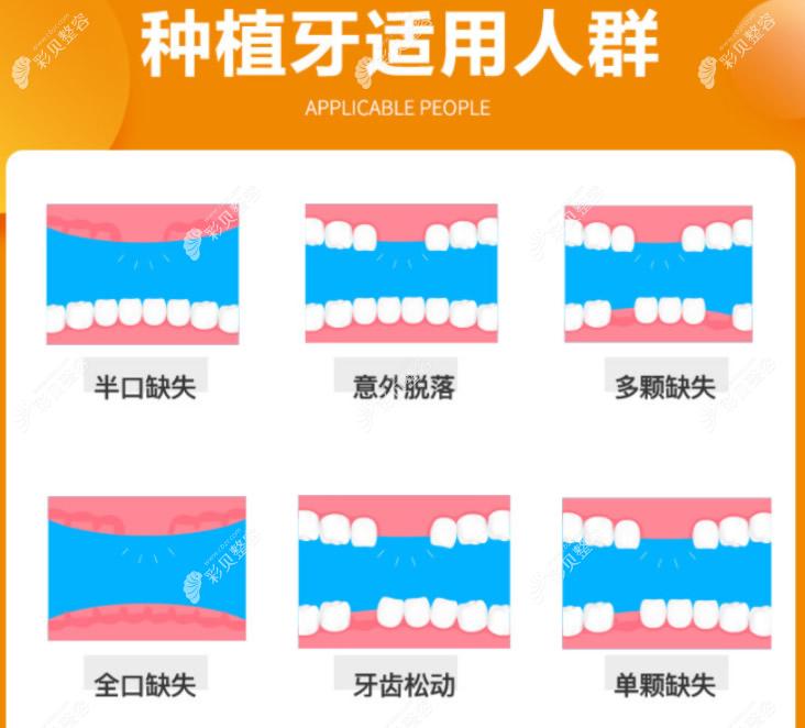 种植牙适合哪些人做