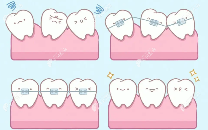牙齿矫治过程