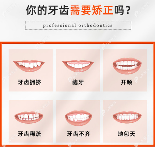 济南蓝山口腔常做的牙齿矫正类型