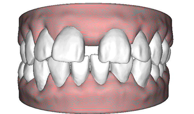 哈尔滨牙齿矫治过程图