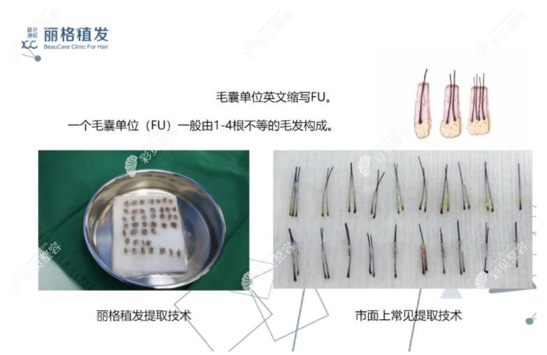 北京丽格植发提取的毛囊怎么样