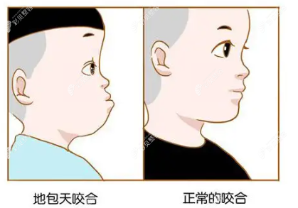 正常咬合和牙齿反颌对比