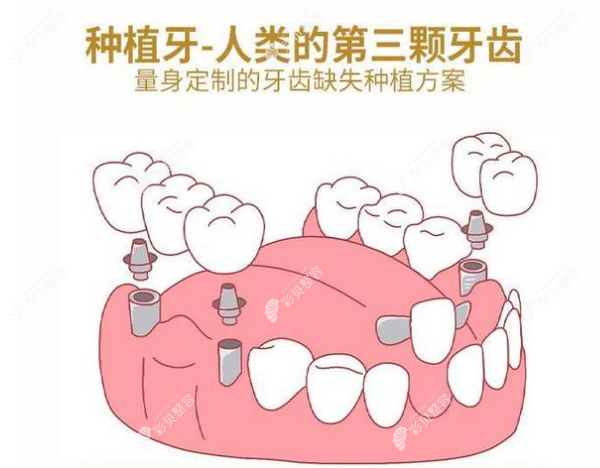 武汉优益佳口腔门诊种植牙多少钱一颗