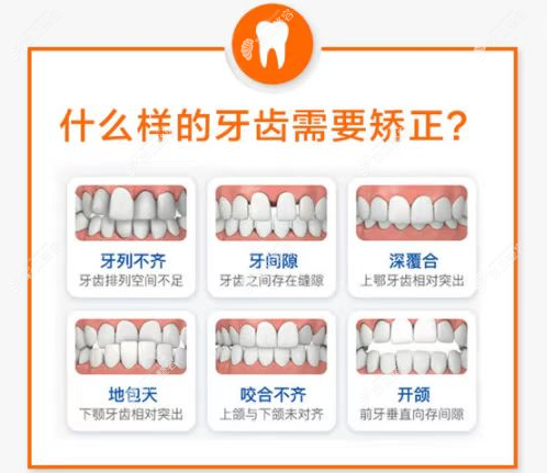 济南弗莱堡口腔做牙齿矫正的类型