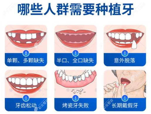 济南美奥口腔做种植牙类型