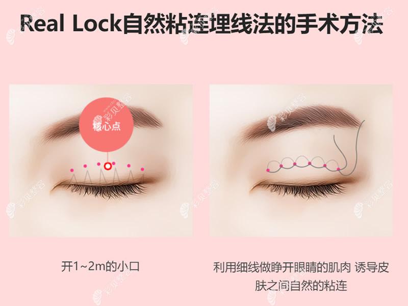 Real Lock自然粘连埋线法双眼皮的原理和操作步骤