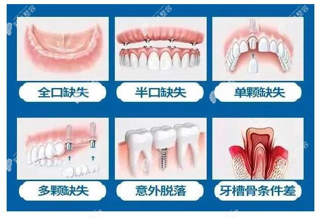 北京全口种植牙价格表