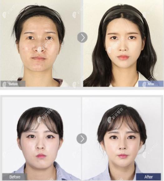 韩国菲斯莱茵整形医院正颌手术矫正脸部不对称图片