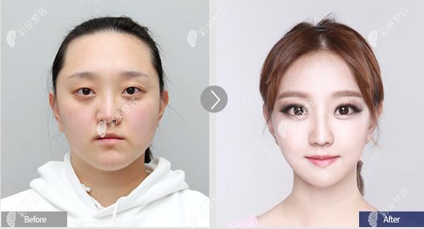 韩国菲斯莱茵医院颧骨改脸型对比照片