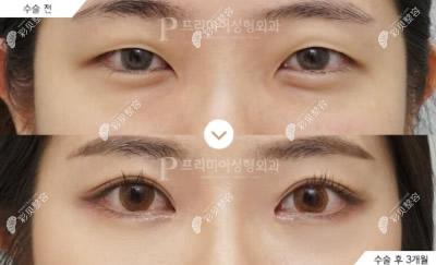 韩国普瑞美医院全切双眼皮+开内眼角+上眼睑去皮去脂真人实例