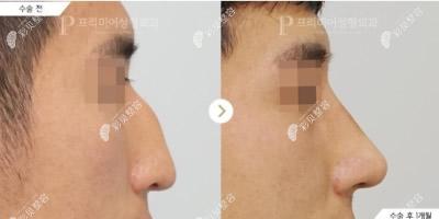 韩国普瑞美整形医院驼峰鼻矫正+肋骨鼻综合实例