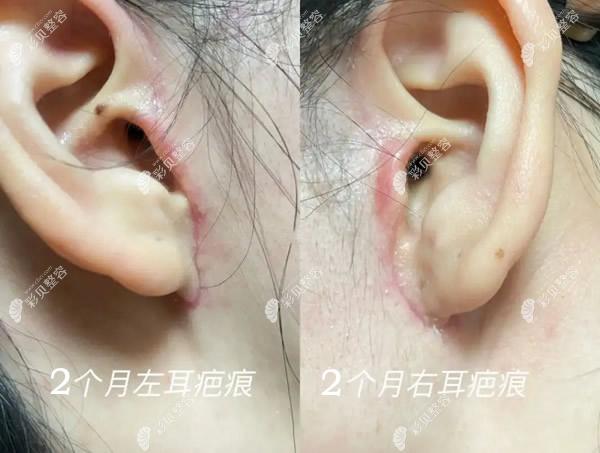 韩国拉菲安医院面部大拉皮手术2个月疤痕图片