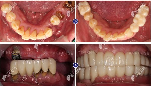 韩国minish口腔医院单颗牙种植和半口牙种植前后对比照片