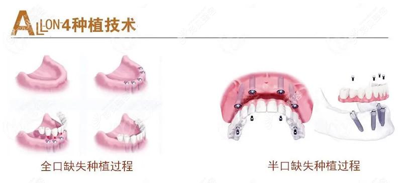 义乌浙口口腔丁大伟医生可以做all-on-4半口或全口种植牙