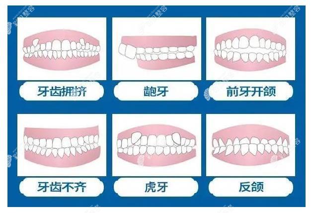 矫正牙套多少钱2022价格表