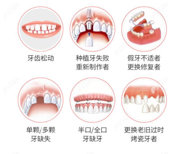 种植牙适合哪些牙齿症状