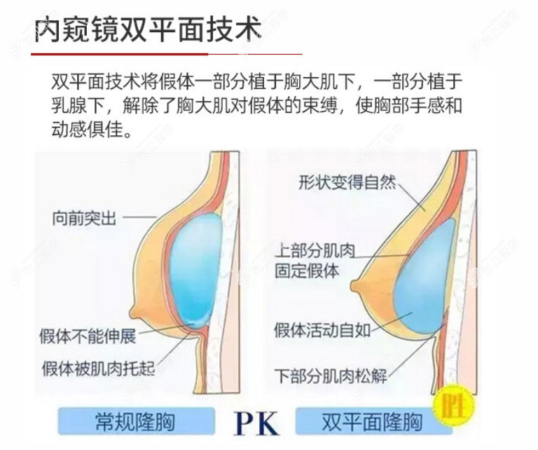 刘月更丰胸技术好不好