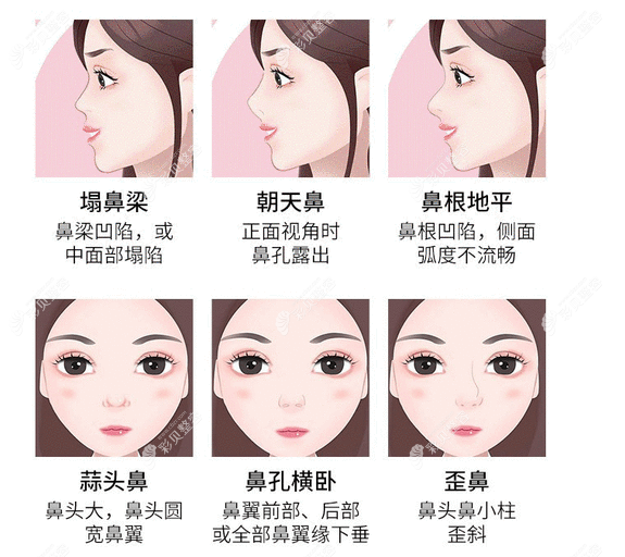 杨水斌医生做鼻子好吗