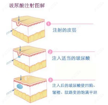 丽丝塔公主针的怎么样