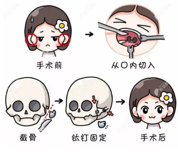 泰国然禧医院颧骨内推手术过程图