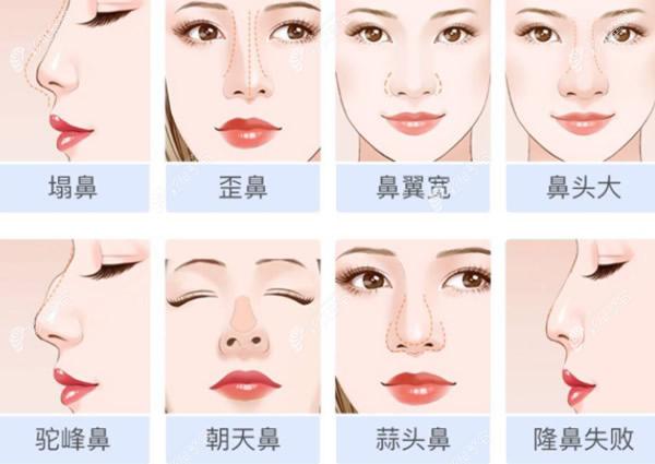 北京嘉禾医院赵作钧医生做鼻子怎么样