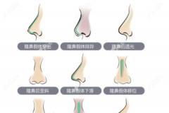 广州鼻修复排名前三医院:广州曙光,荔医和美莱修复鼻子出名