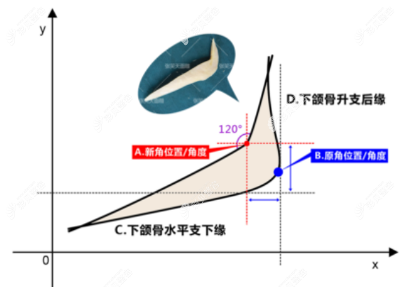 北京圣嘉新医院磨骨