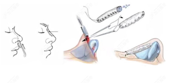 全肋软骨鼻综合一般多少钱左右