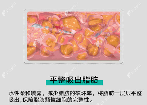 李国伟医生面部吸脂好吗