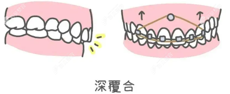 牙齿矫正要打骨钉吗www.cbzr.com