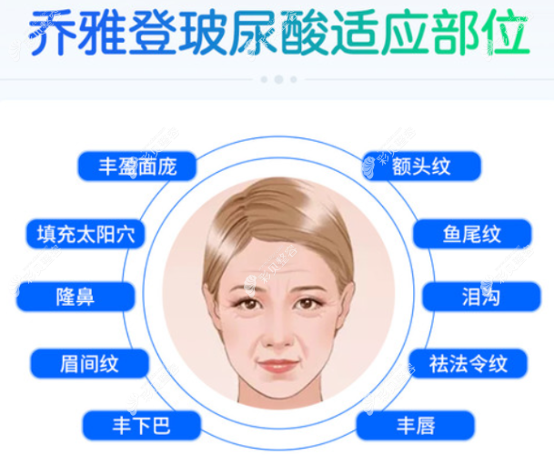 乔雅登丰颜和丰颜xc玻尿酸适应部位不同