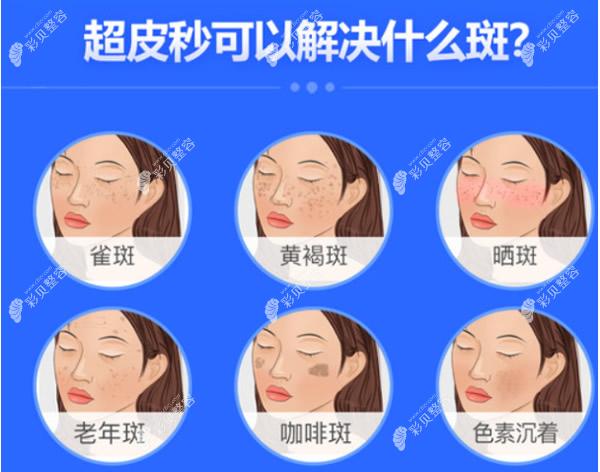 郴州余悦整形蔡意医生超皮秒祛斑怎么样