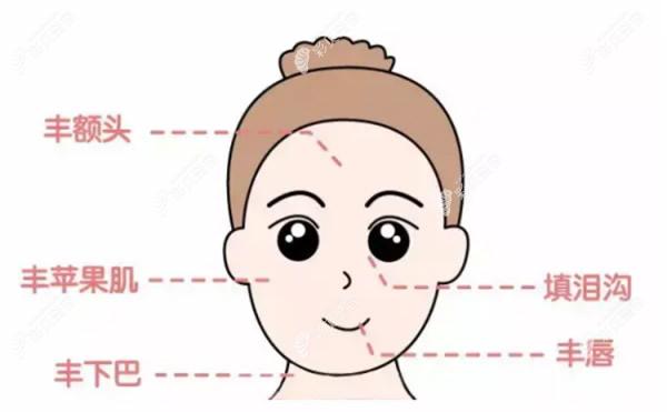 玻尿酸填充面部部位