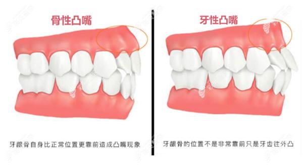 骨性凸嘴和牙性凸嘴的区别
