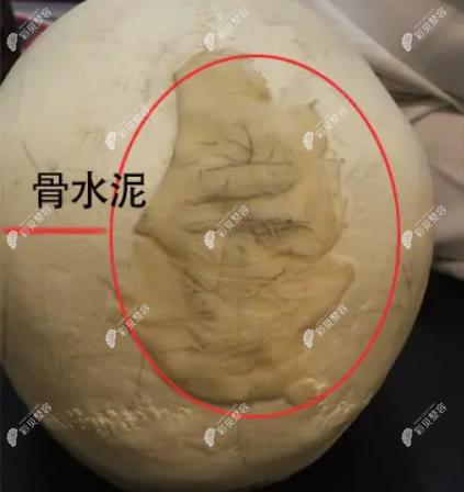 骨水泥修补颅骨怎么样