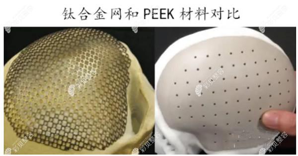 钛合金网和peek人工骨材料区别