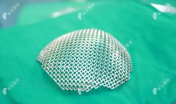 钛合金修补颅骨怎么样